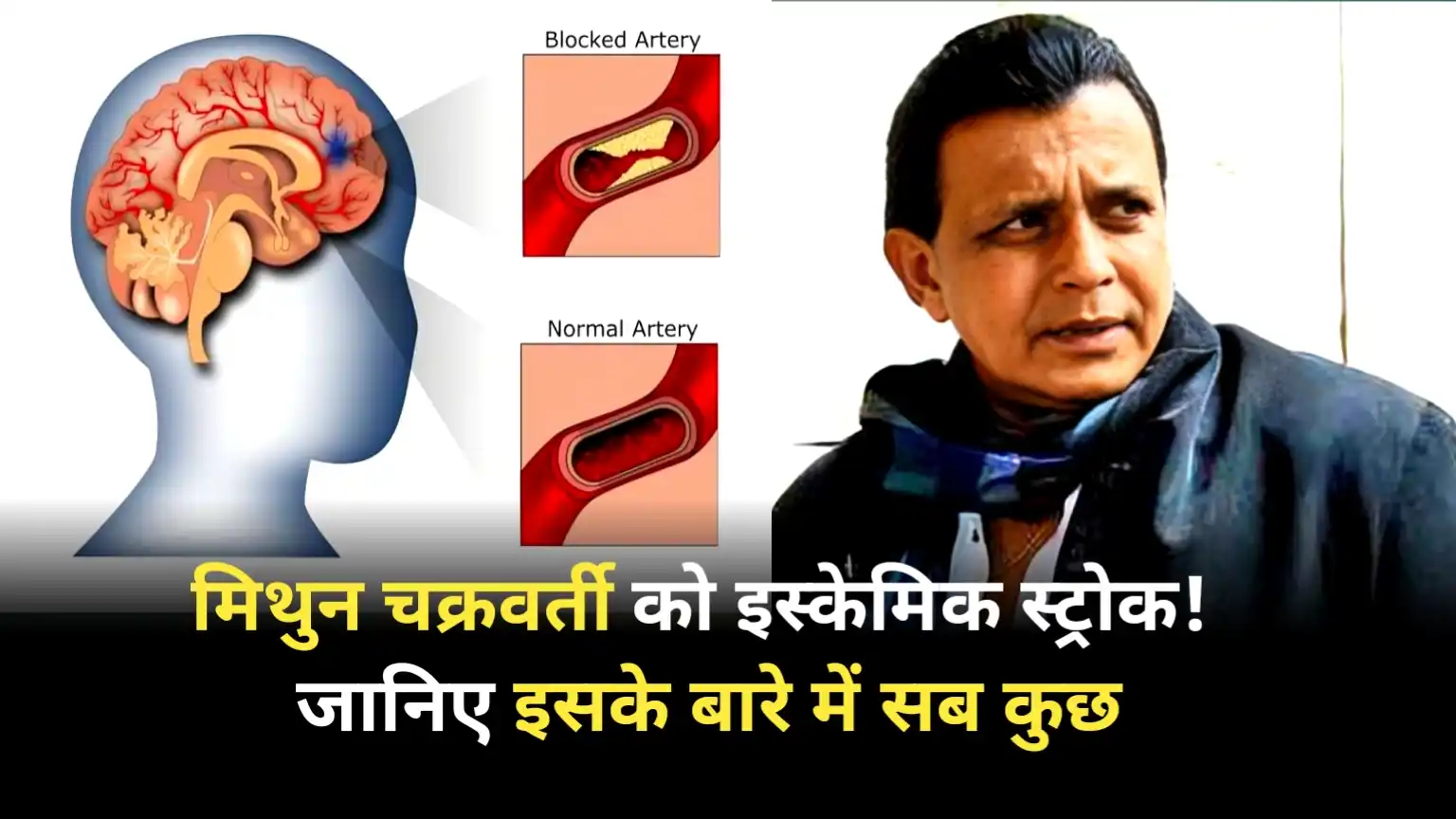 Mithun Chakraborty suffers ischemic stroke! Learn everything about it